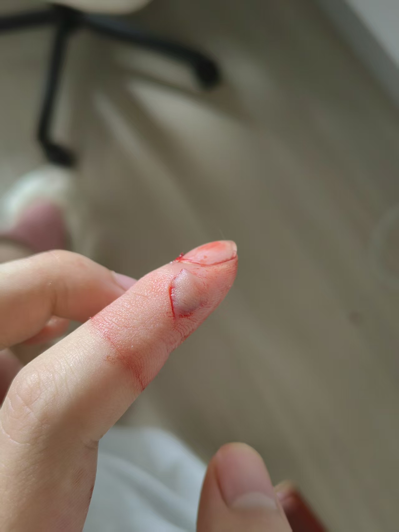 手指受伤
